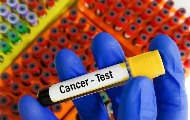 Tumor Markers Tests at Biocheck Pathology